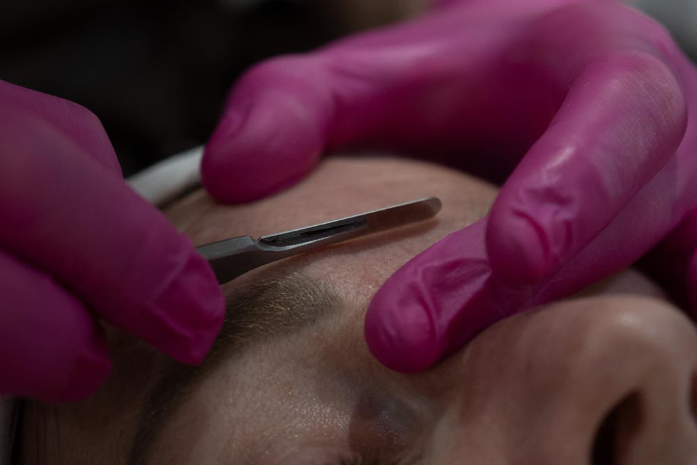 dermaplaning-2