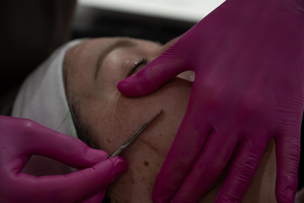 dermaplaning